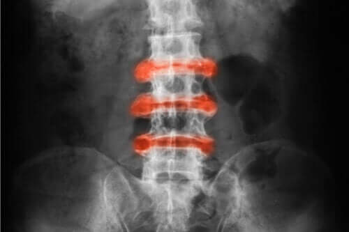 Journée mondiale de la spondylarthrite ankylosante : bien-être émotionnel