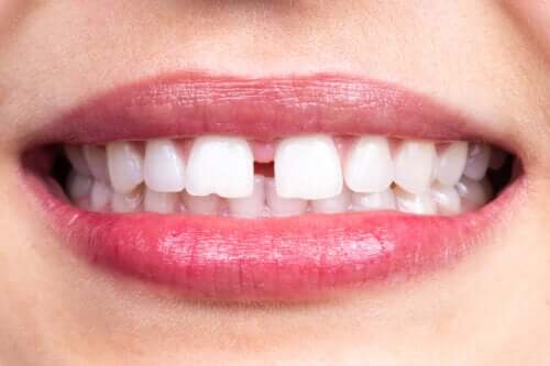 Diastème : en quoi consiste-t-il ?