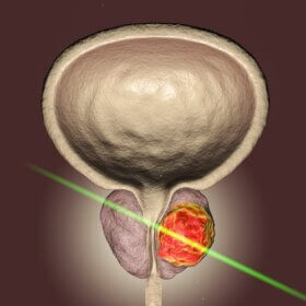 Le laser : une percée scientifique pour la chirurgie de la prostate