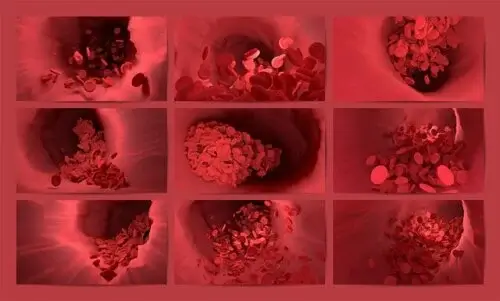 Fibrinolyse : un processus qui empêche la formation d'un thrombus