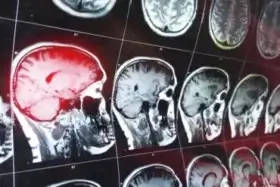 Hématome intracrânien : qu'est-ce que c'est et comment le traiter ?