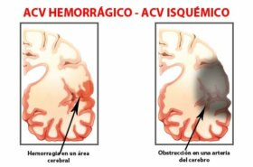 Les premiers symptômes d'un AVC