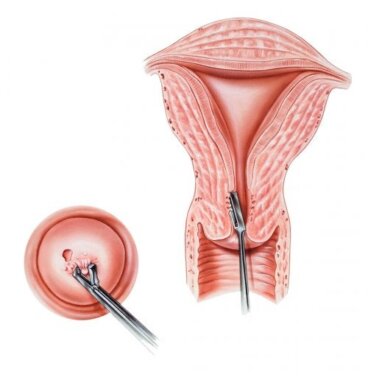 Quand faut-il faire une biopsie du col de l'utérus ?