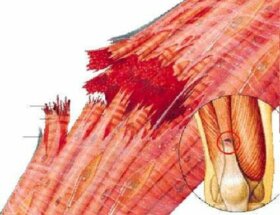 Comment traiter naturellement une déchirure musculaire ?