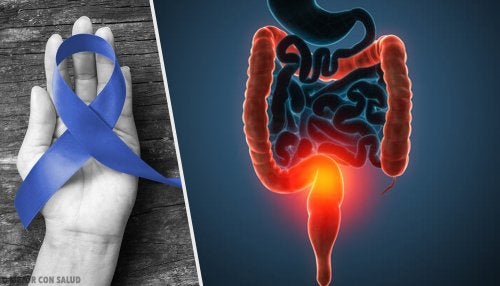 Principales causes du cancer du côlon