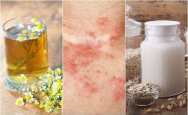 5 remèdes maison pour traiter la dermatite de contact