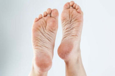 3 crèmes naturelles pour éliminer les callosités des pieds
