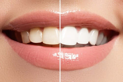 9 aliments qui peuvent endommager l'émail des dents