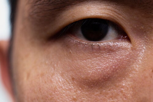 Ptose ou paupière tombante : causes, signes et traitements