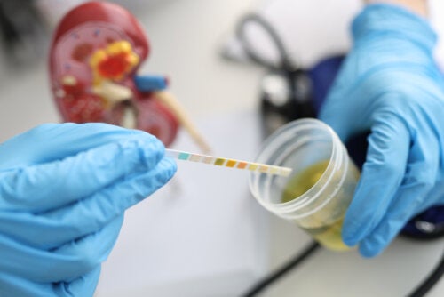 Urobilinogène dans l'urine : causes et valeurs normales