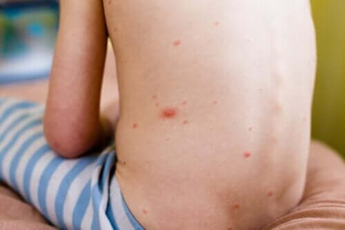 Molluscum contagiosum : caractéristiques, diagnostic et traitement