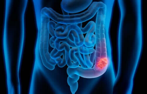 Des scientifiques espagnols découvrent les cellules responsables de la rechute du cancer du côlon
