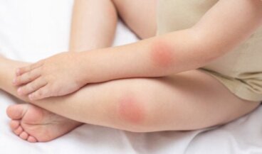 Taches rouges sur la peau : 25 causes possibles et traitements