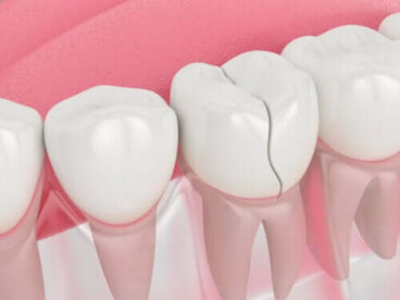 Fissure dentaire : comment agir et la traiter correctement ?