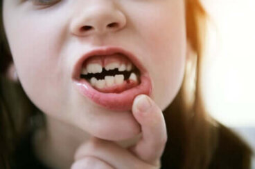 Les molaires qui apparaissent à 6 ans, les premières dents définitives chez l'enfant