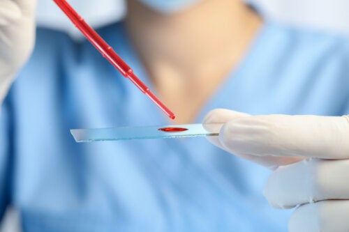 Leucémie chronique à éosinophiles : symptômes, diagnostic et traitement