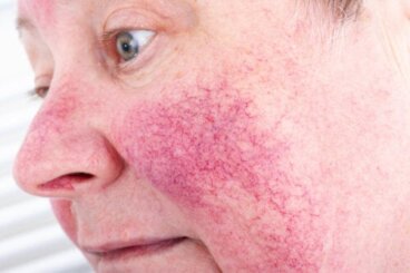 15 maladies de peau courantes et comment les traiter