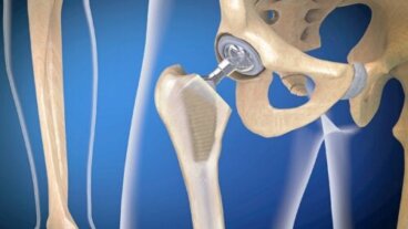 Infection de prothèse articulaire : quelles sont les causes?