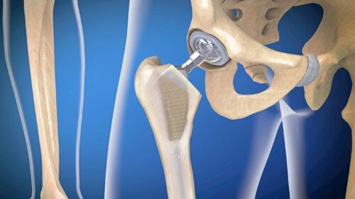 Infection de prothèse articulaire : quelles sont les causes?